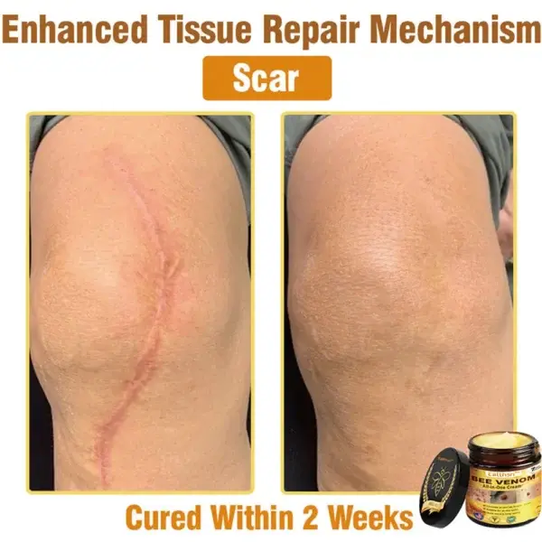 Ealthsn™ Botulinum Toxin & Bee Venom Pain-Relief Bone Healing Cream